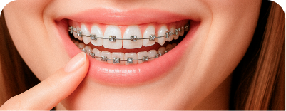 Brackets metálicos
